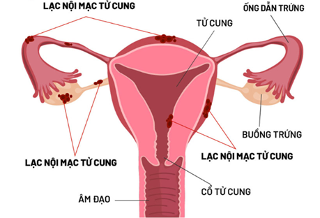 Bệnh lý lạc nội mạc tử cung và hiếm muộn