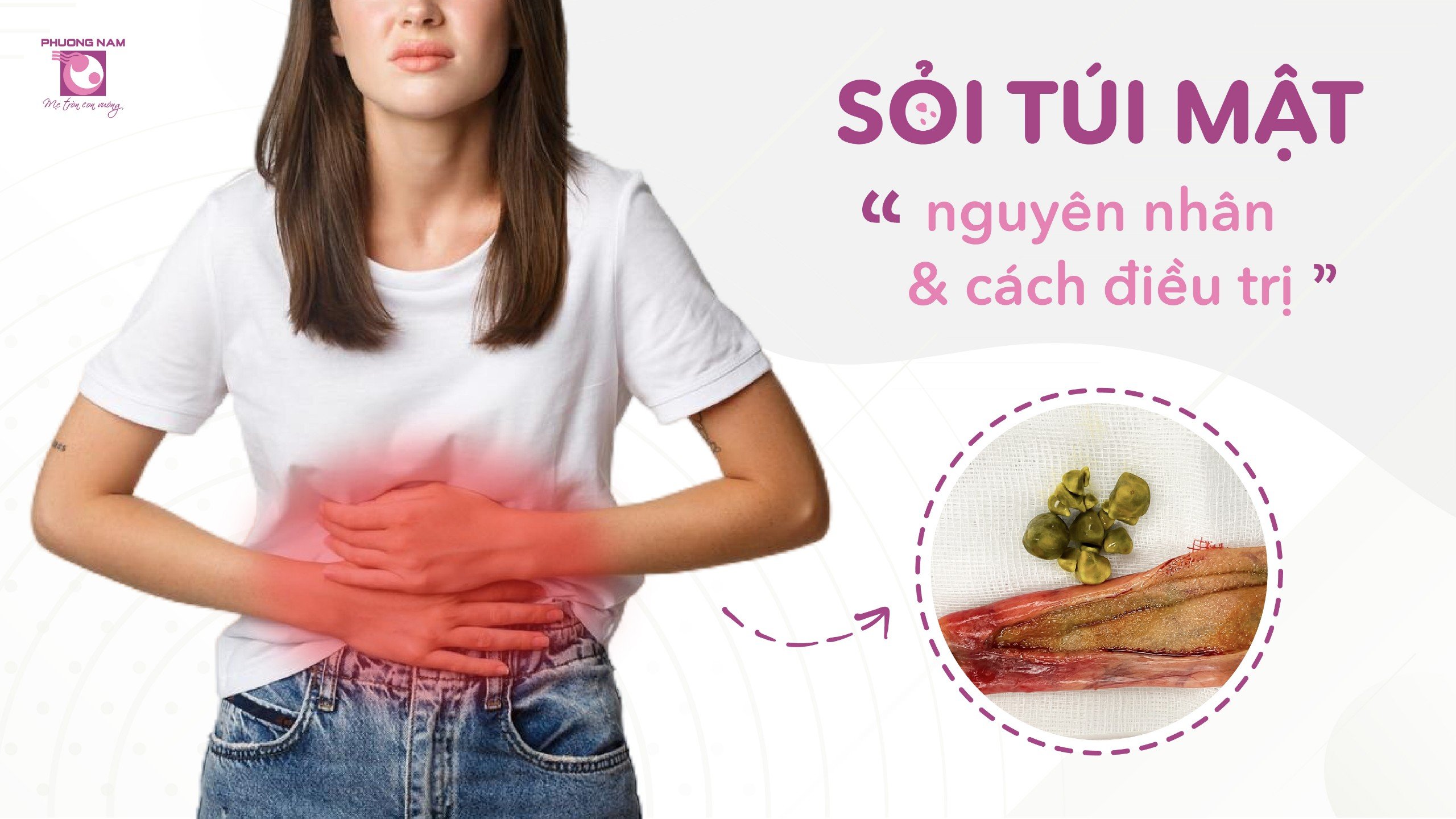 Sỏi túi mật và các phương pháp điều trị hiện nay