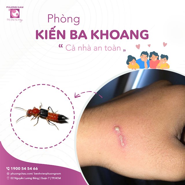 Viêm da tiếp xúc do kiến ba khoang và những điều cần biết