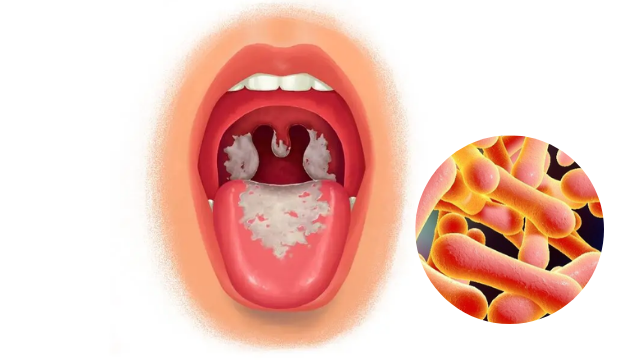 Bệnh bạch hầu: Những điều cần biết để phòng tránh bệnh