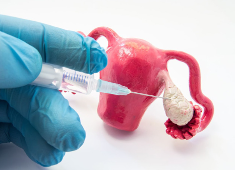 Phương pháp kích thích buồng trứng trong điều trị hiếm muộn