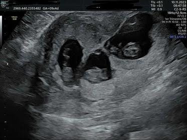 Giảm thai trong đa thai khi thực hiện thụ tinh trong ống nghiệm