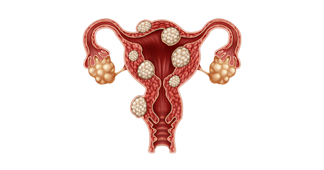 U xơ tử cung là gì ? U xơ tử cung có nguy hiểm không?