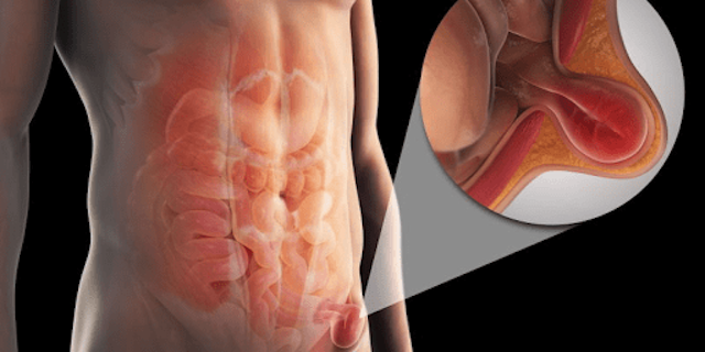 Thoát vị bẹn ở trẻ em và tất cả những điều cha mẹ cần biết