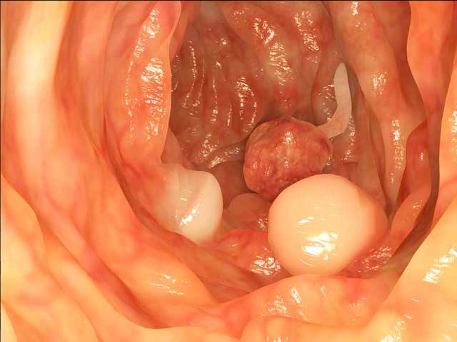 Nội soi đại tràng có đau không?