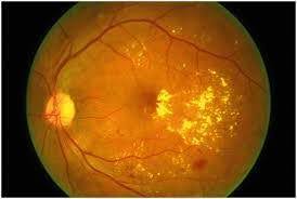 Bệnh võng mạc tiểu đường - biến chứng nguy hiểm chớ nên xem thường