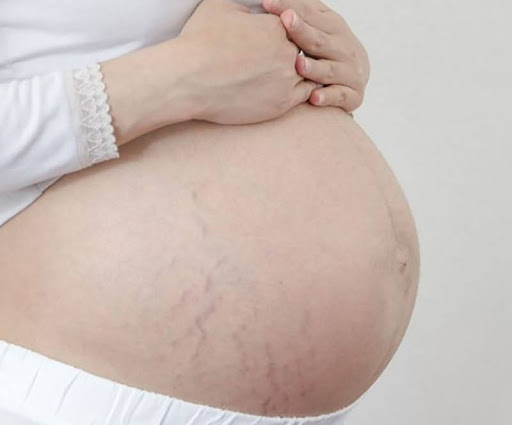 Rạn da khi mang thai: Nỗi lo lắng của rất nhiều mẹ bầu