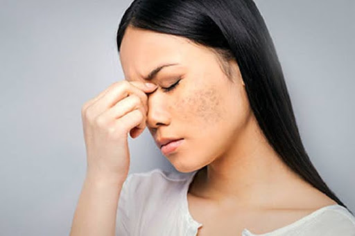 Nám da khi mang thai: Hiểu rõ để bớt lo lắng