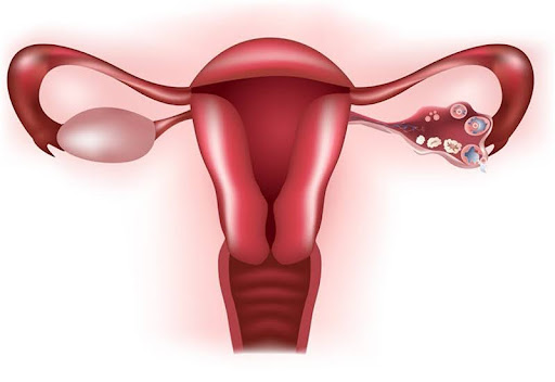 Tắc ống dẫn trứng: Triệu chứng, nguyên nhân, chẩn đoán và điều trị
