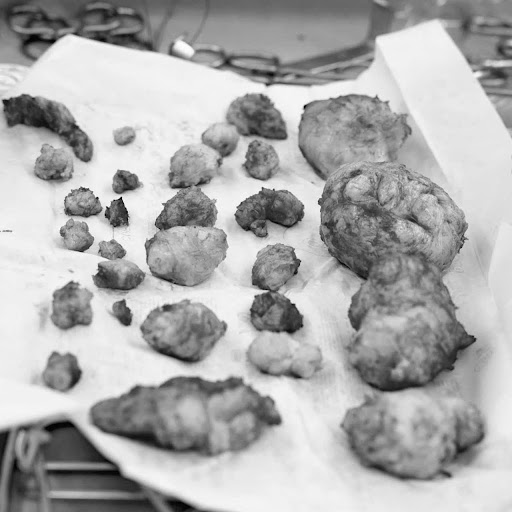 Bóc tách 28 khối u xơ trong tử cung - Hành trình 4 tiếng giữ lại cơ hội làm mẹ