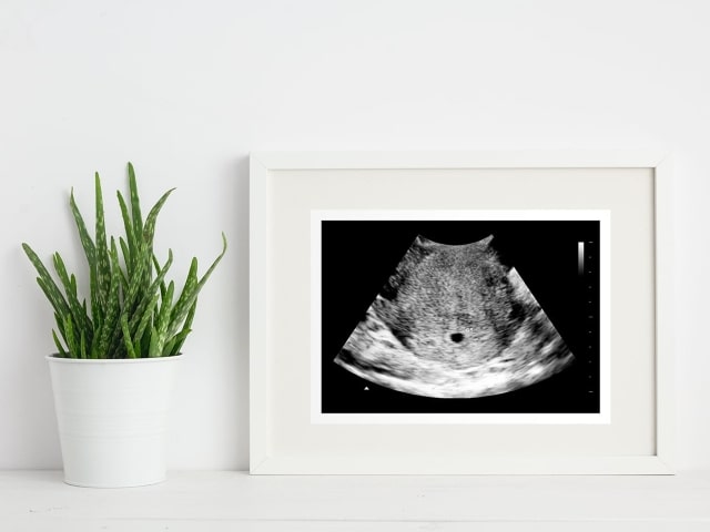 4 tuần siêu âm thấy túi thai chưa và điều mẹ bầu nên làm