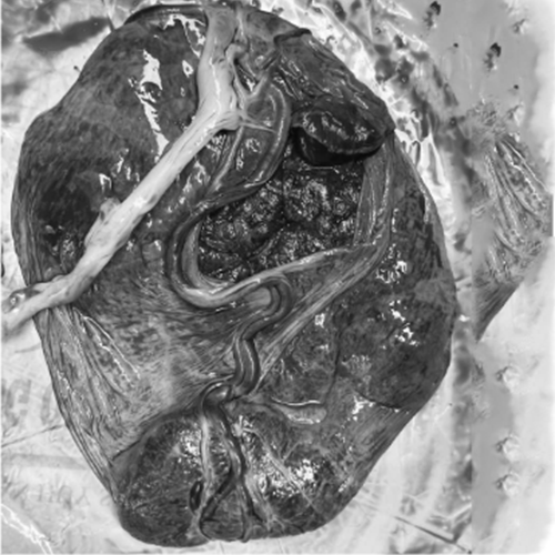 Ca bệnh cực hiếm với tỷ lệ mắc 4/10.000