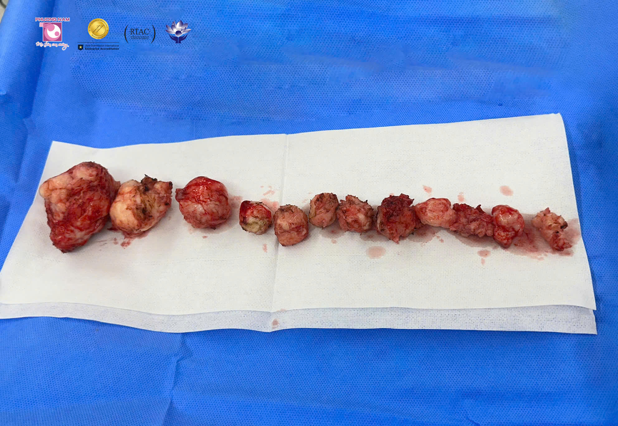 Bóc tách12 khối u xơ tử cung: Quyết định "xoay chuyển" đầy bản lĩnh