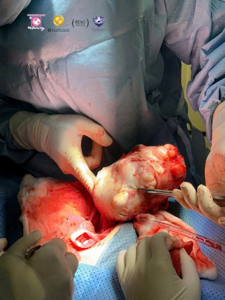 Bảo tồn tử cung thành công trong ca u xơ tử cung to hiếm gặp