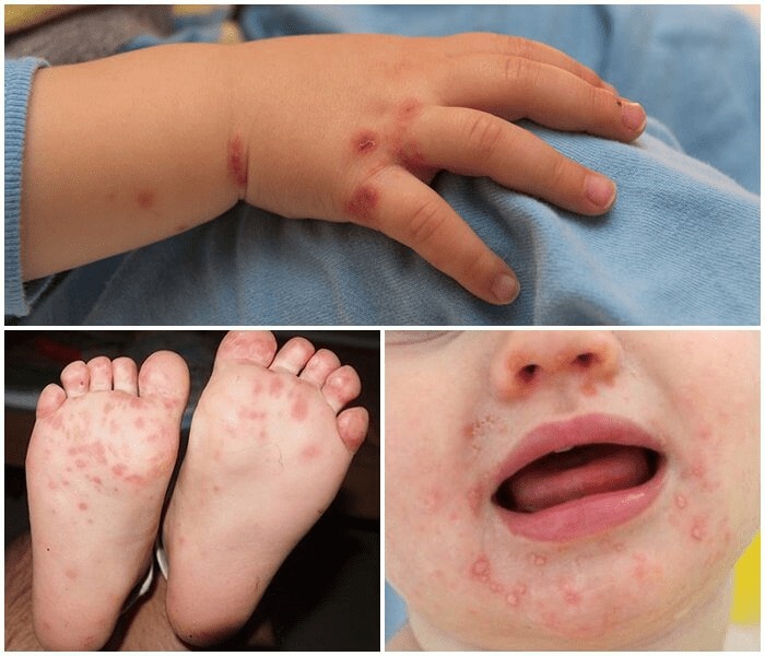 Tay chân miệng vào mùa trở lại: Đừng chủ quan với những cơn sốt nhẹ