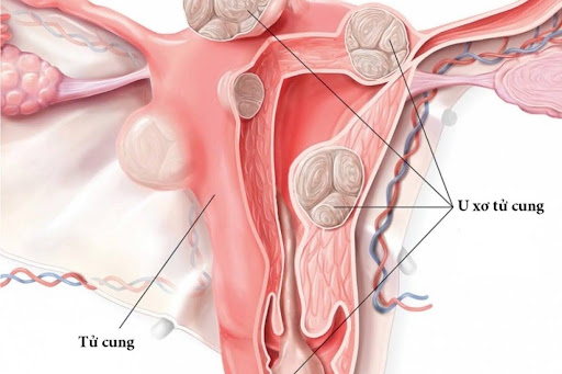 U xơ tử cung: Những điều chị em cần biết về khối u lành phổ biến
