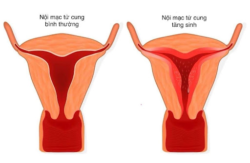 Tăng sinh niêm mạc tử cung: Hiểu rõ để không chủ quan