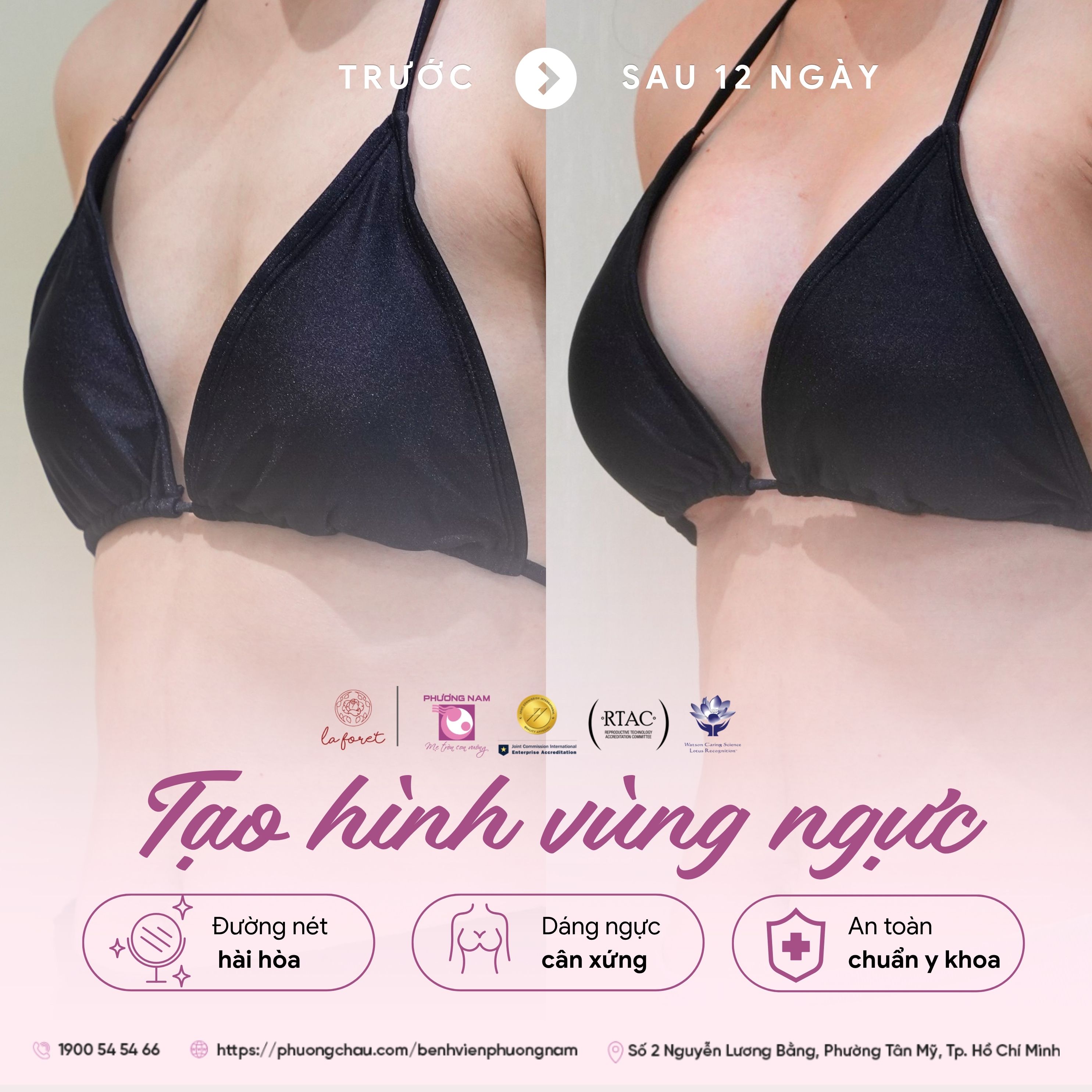 Cẩm nang Nâng ngực Thẩm mỹ