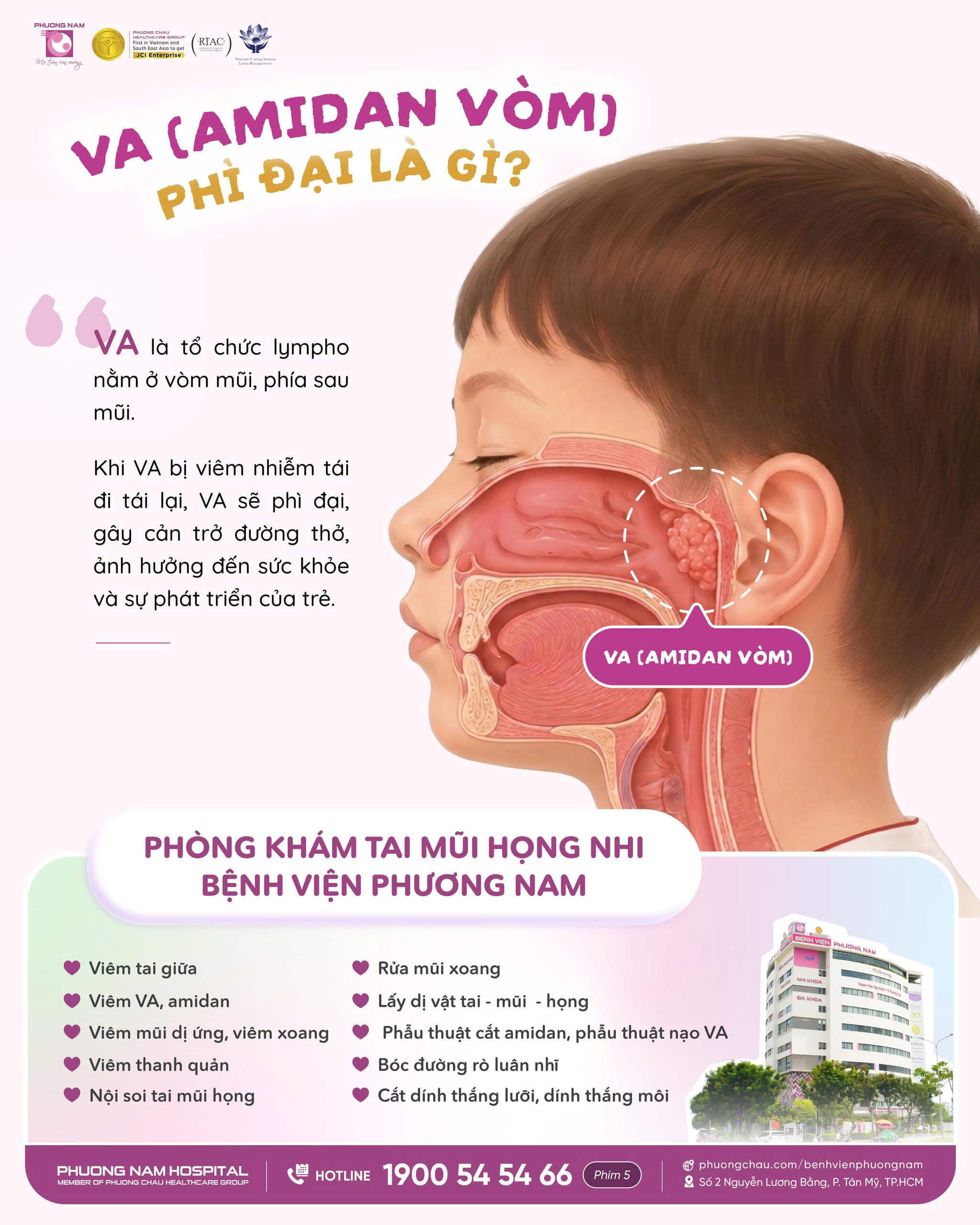 Viêm và phì đại VA (Amidan vòm họng) ở trẻ em