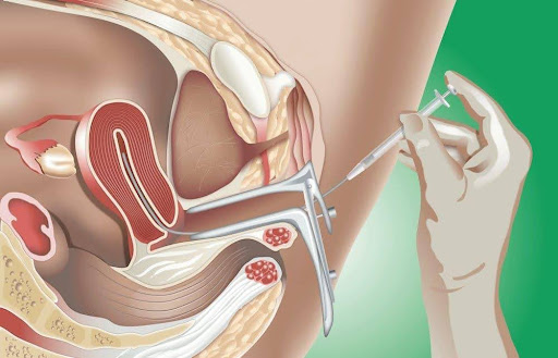 Hình ảnh minh họa thủ thuật phương pháp IUI