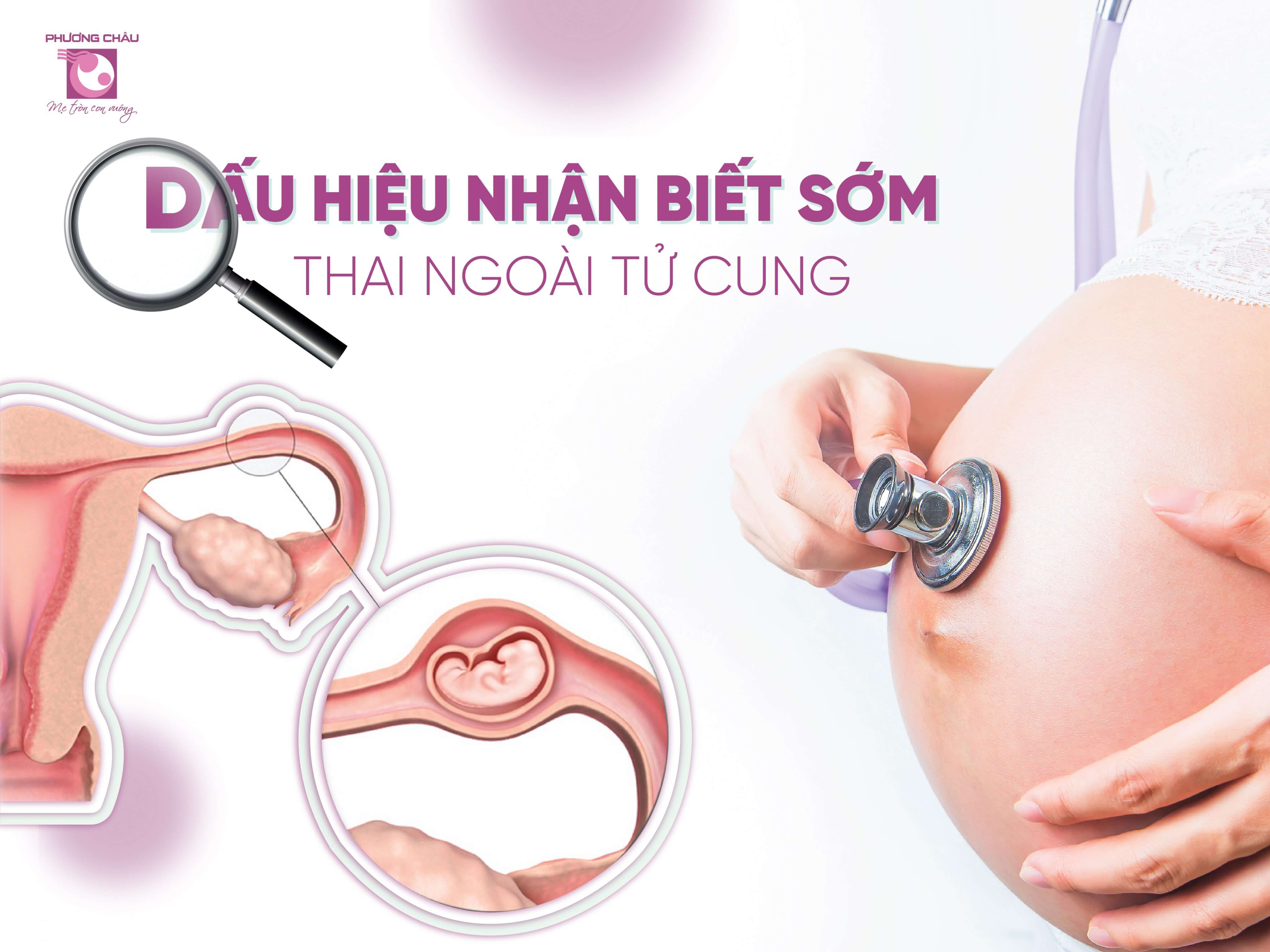 Dấu hiệu nhận biết sớm thai ngoài tử cung.