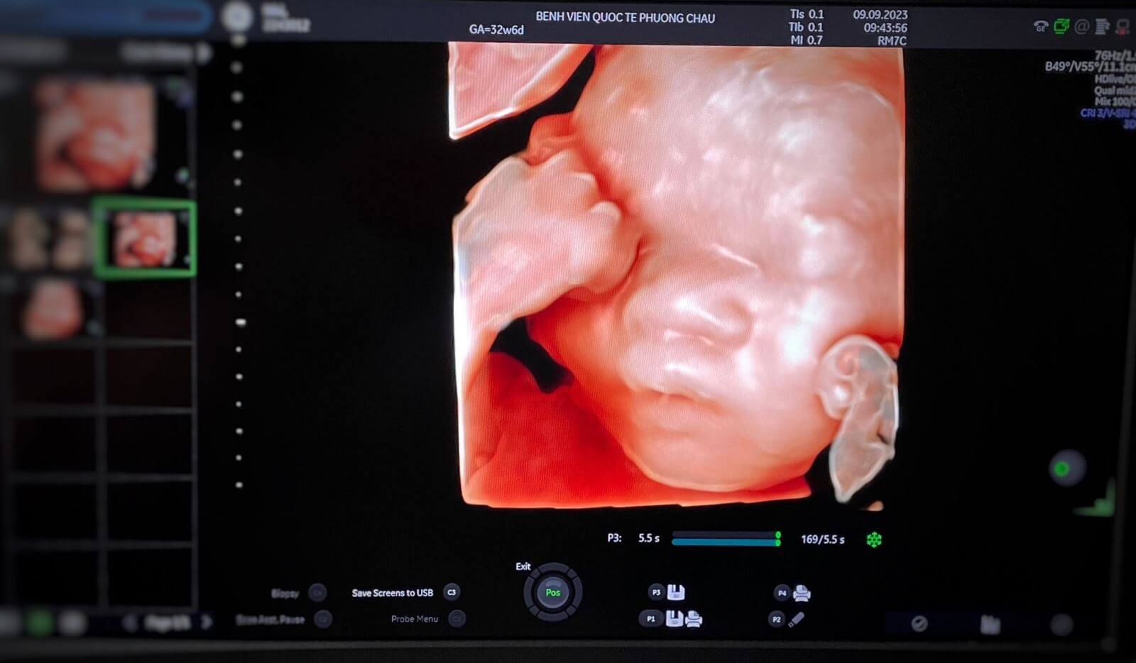 BVQT Phương Châu trang bị máy siêu âm sản phụ khoa voluson expert 22 hiện đại nhất thế giới