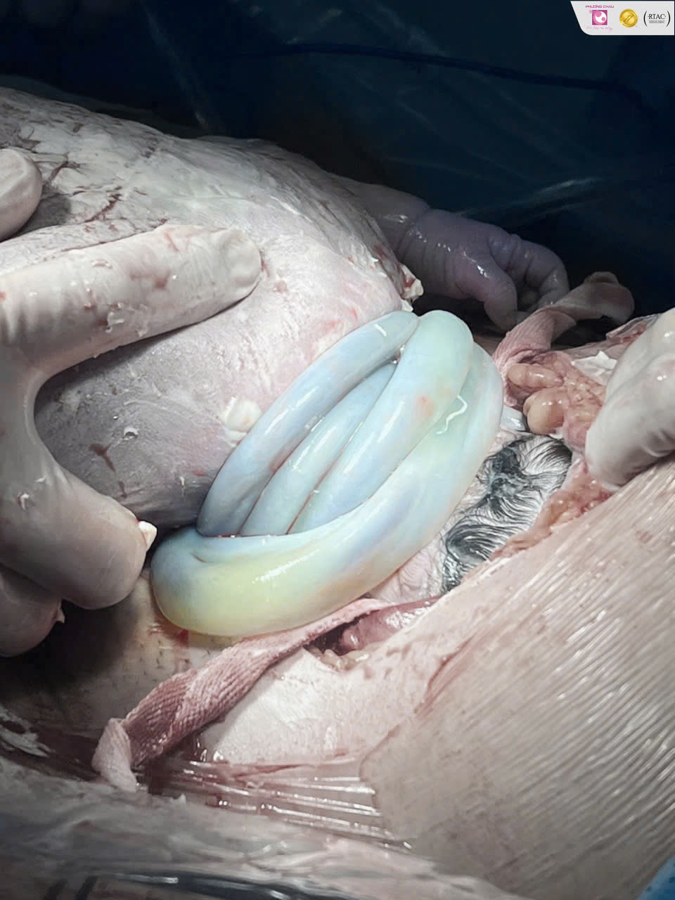 Bé Gái Chào Đời An Toàn Với Dây Rốn Quấn Cổ 5 Vòng