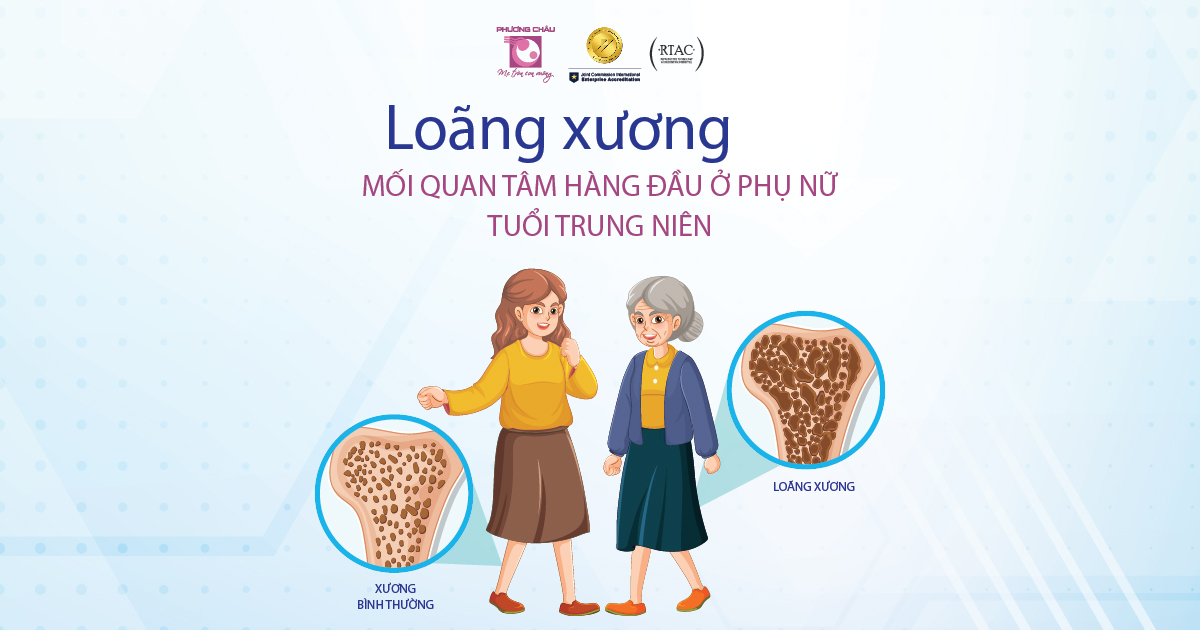 Loãng xương: Mối quan tâm hàng đầu của phụ nữ tuổi trung niên