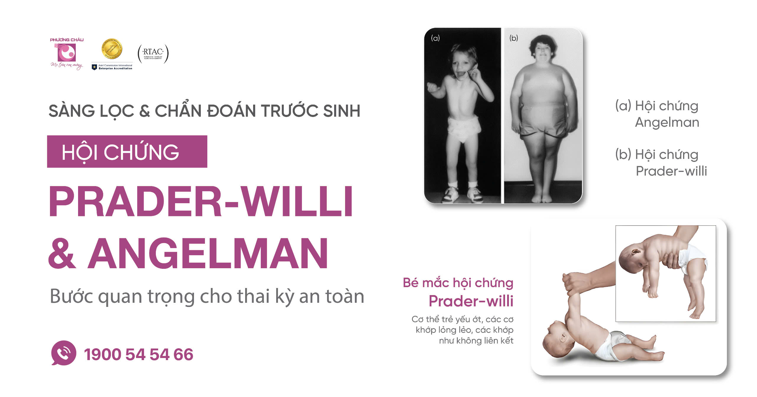 Sàng Lọc Và Chẩn Đoán Trước Sinh Hội Chứng Prader-Willi / Angelman
