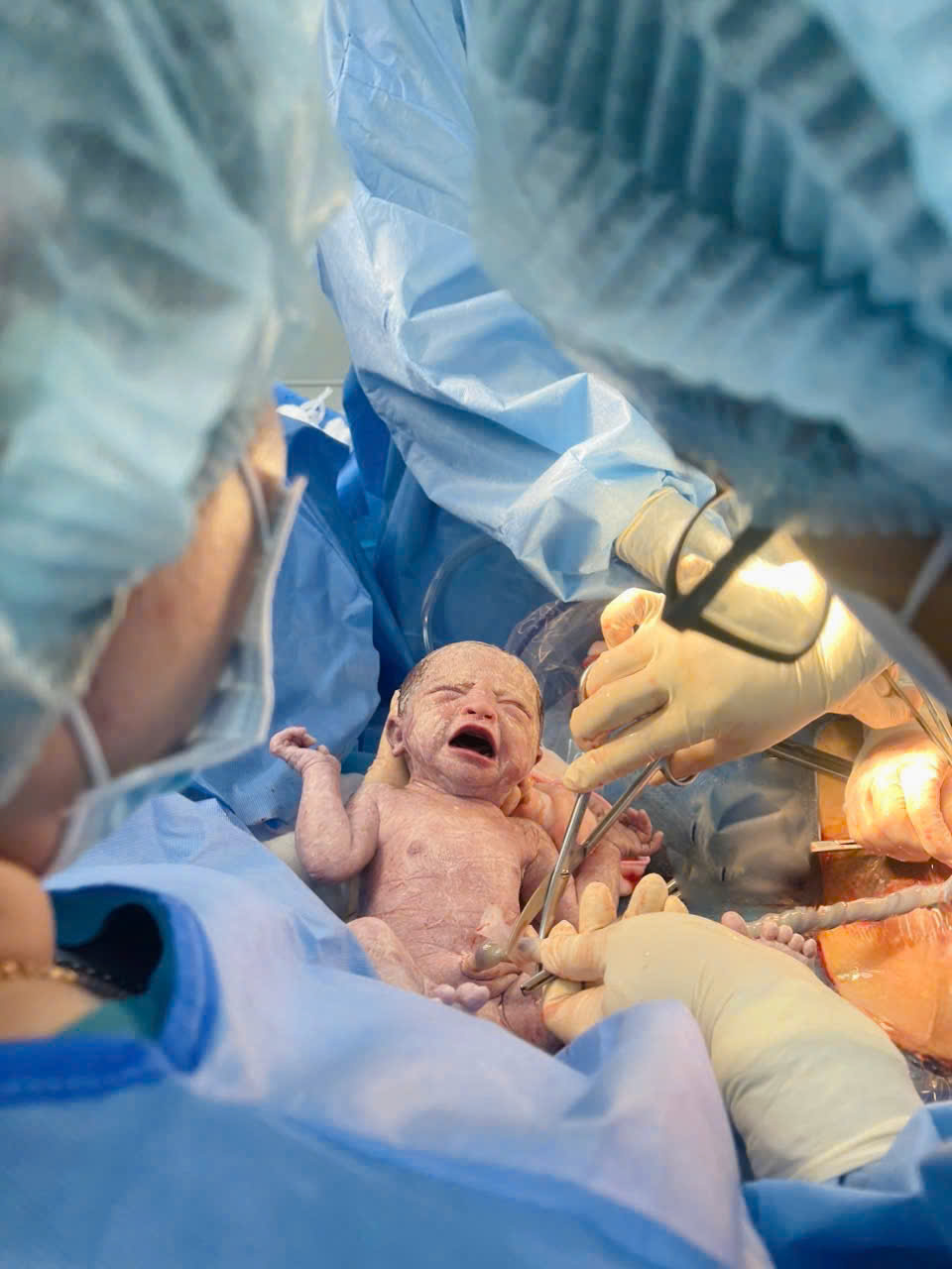 Kỳ Tích Vượt Cạn An Toàn Của Mẹ Bầu Mắc Lupus Ban Đỏ Hệ Thống Và Hội Chứng Thận Hư