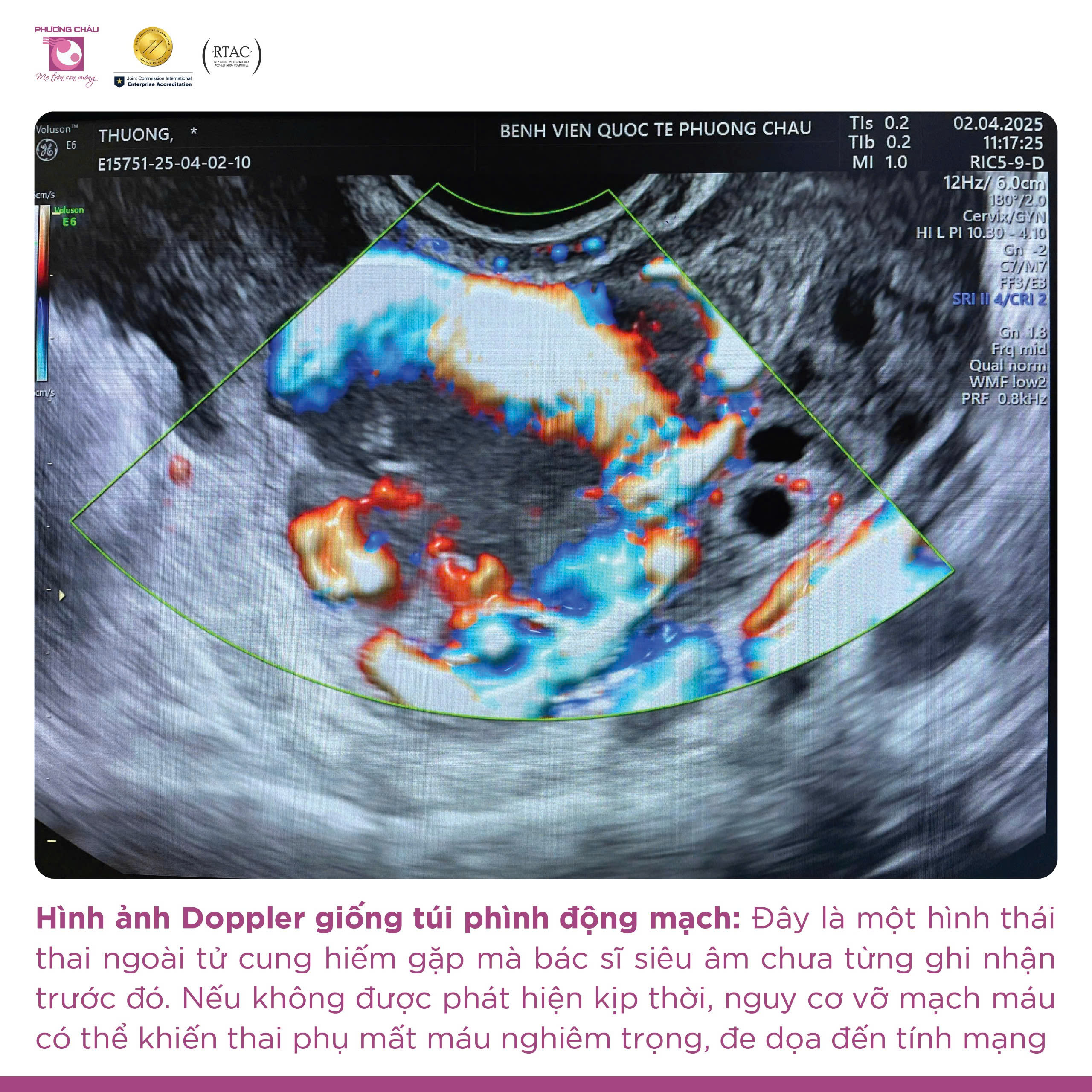 Thai ngoài tử cung có nguy cơ vỡ – Phát hiện muộn nhưng xử trí kịp thời tại Phương Châu