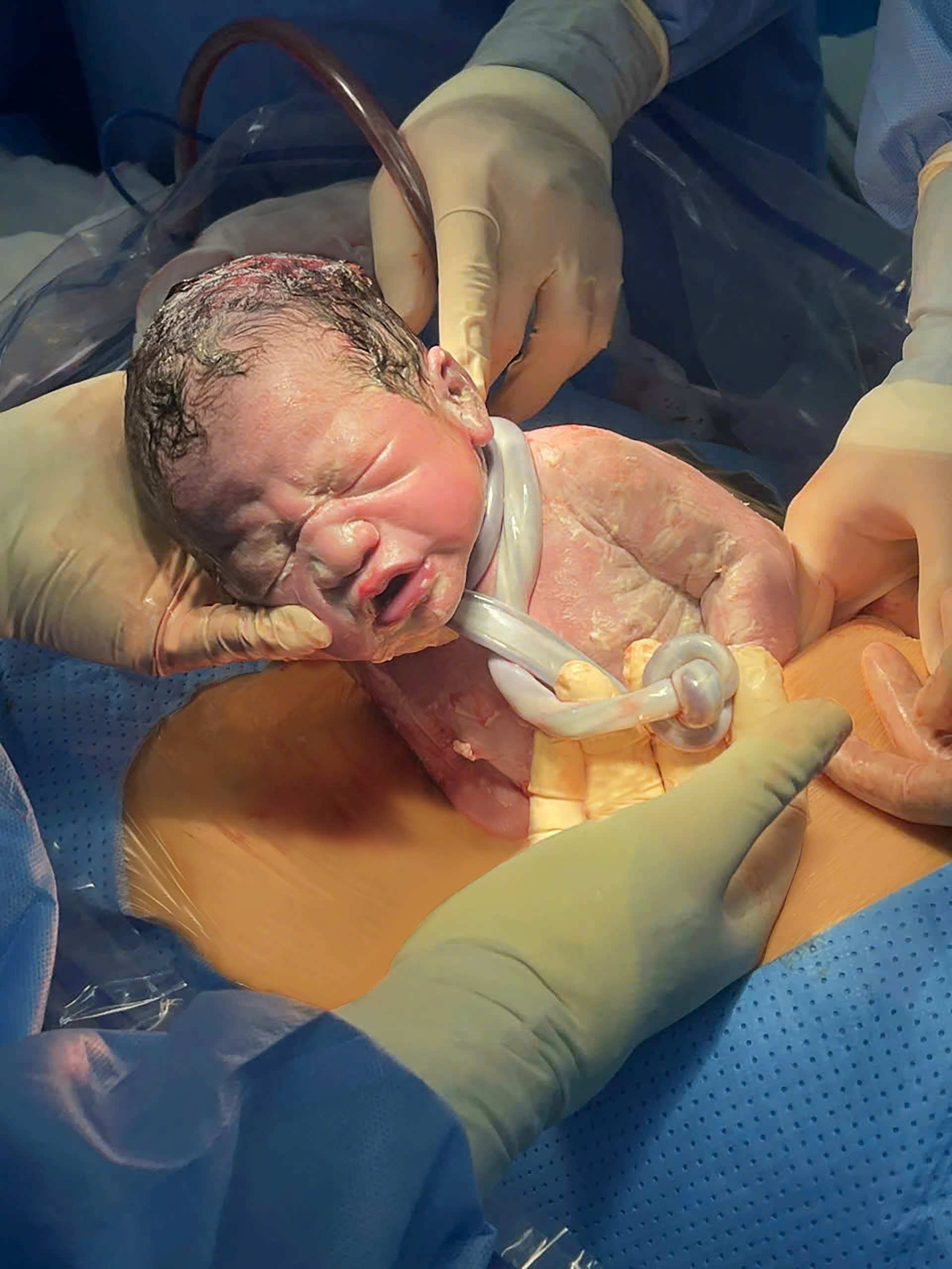 Dây Rốn Quấn Cổ 3 Vòng Kèm Nút Thắt – Những Nguy Cơ Tiềm Ẩn Và Giải Pháp An Toàn Tại Phương Châu