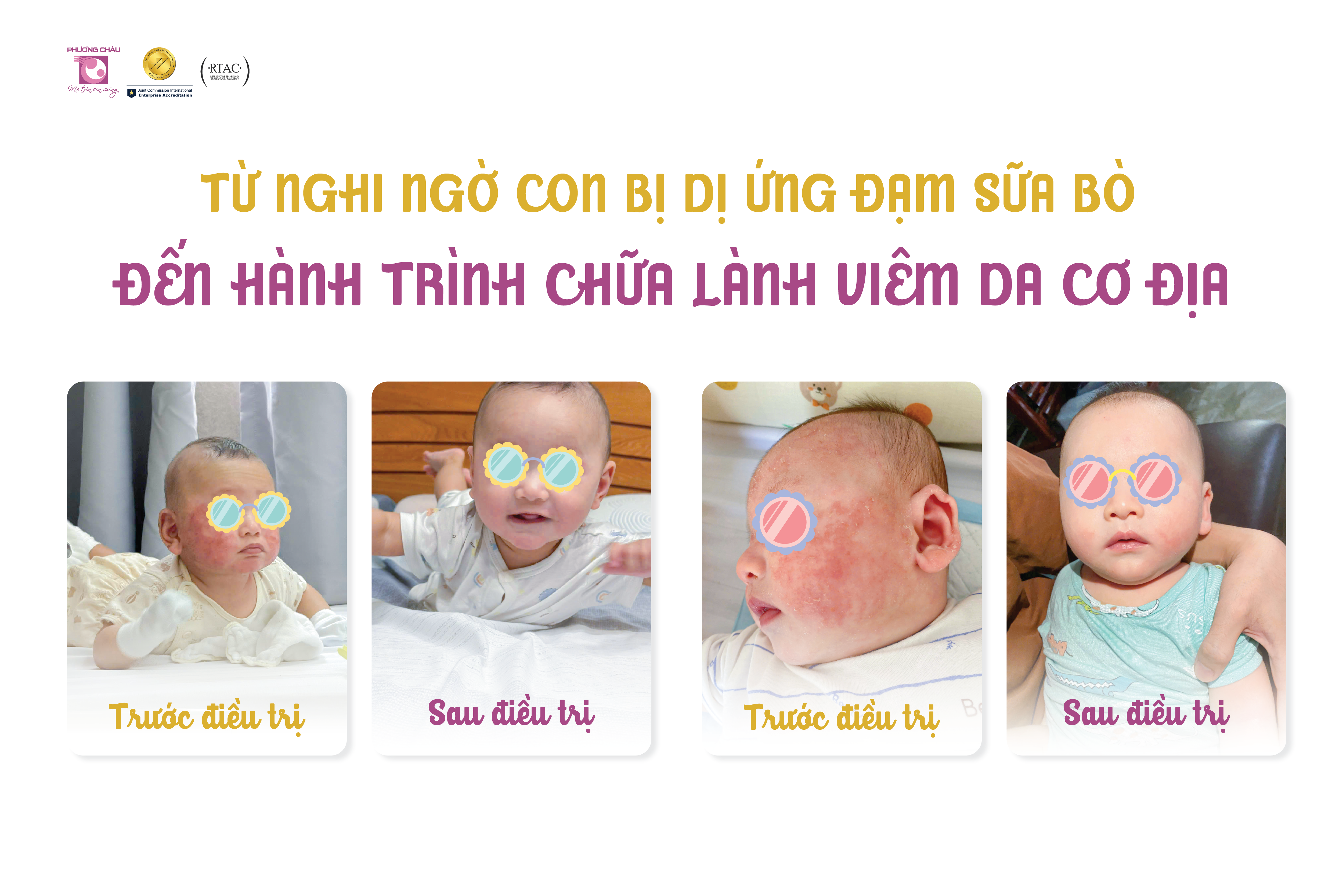 TỪ NGHI NGỜ CON BỊ DỊ ỨNG ĐẠM SỮA BÒ ĐẾN CHỮA LÀNH VIÊM DA CƠ ĐỊA