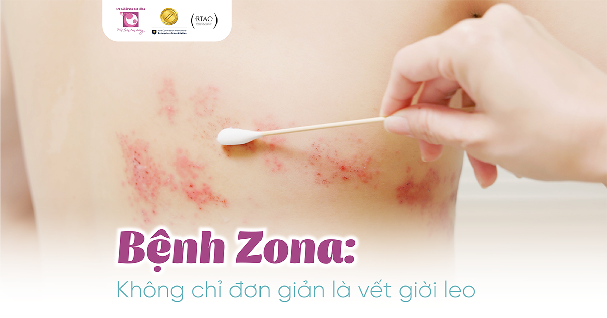 Bệnh zona: Không đơn giản chỉ là vết giời leo