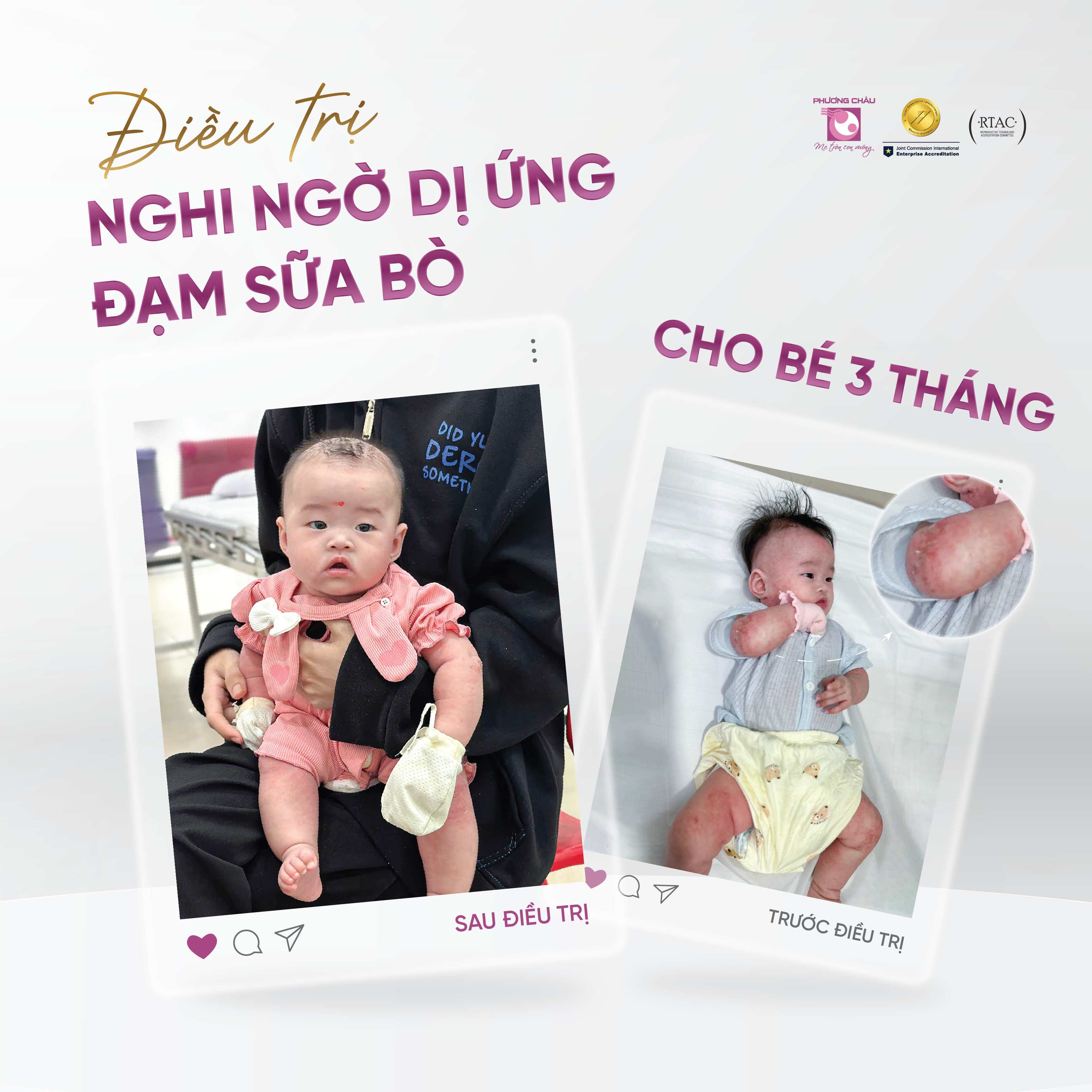 ĐIỀU TRỊ NGHI NGỜ DỊ ỨNG ĐẠM SỮA BÒ CHO BÉ 3 THÁNG