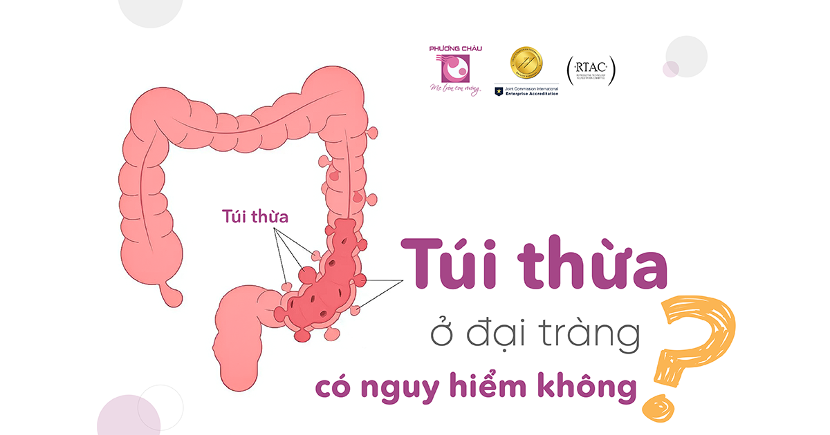 Viêm túi thừa đại tràng: Nguyên nhân, triệu chứng và cách điều trị