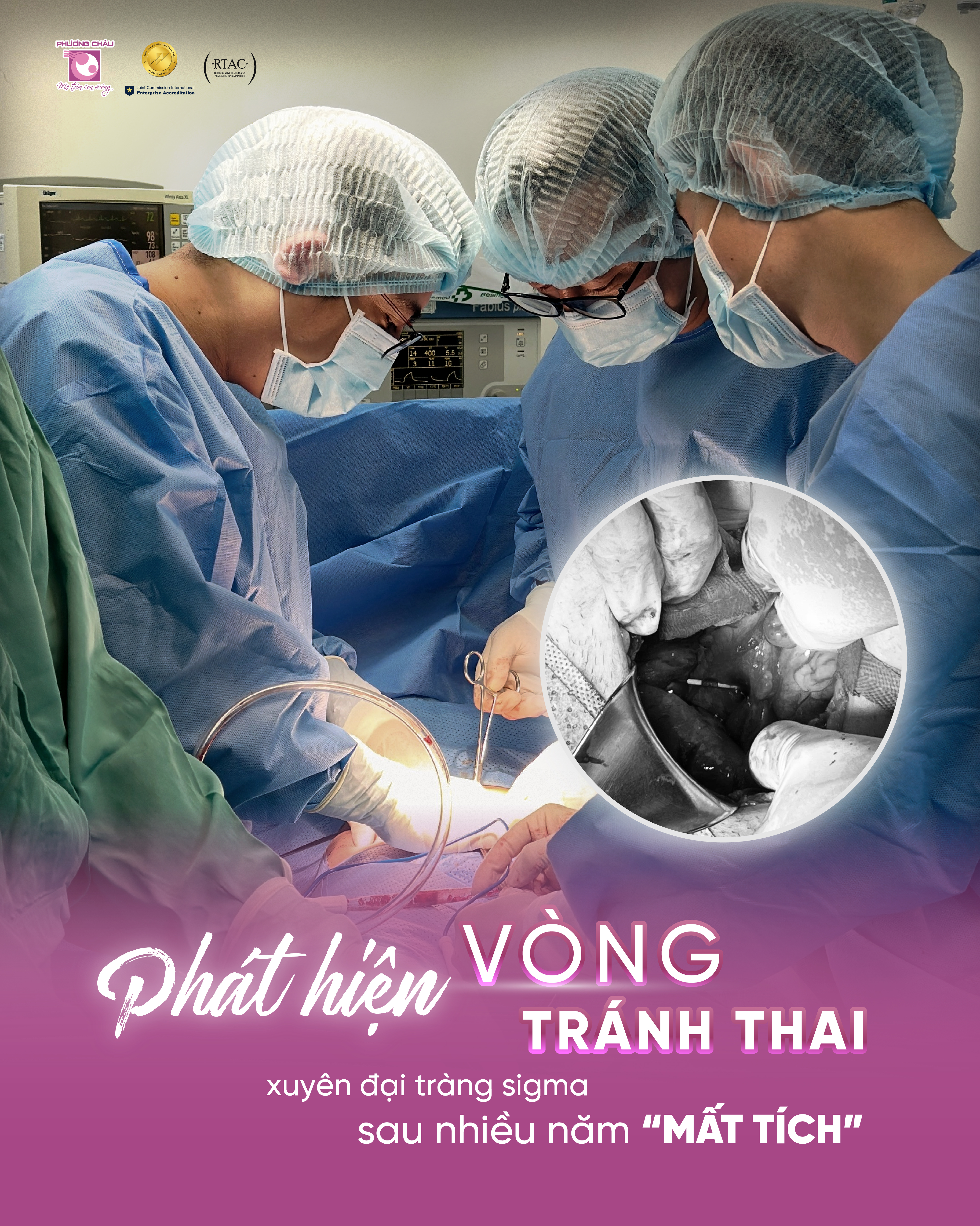 PHÁT HIỆN VÒNG TRÁNH THAI XUYÊN CƠ TỬ CUNG SAU NHIỀU NĂM “MẤT TÍCH”