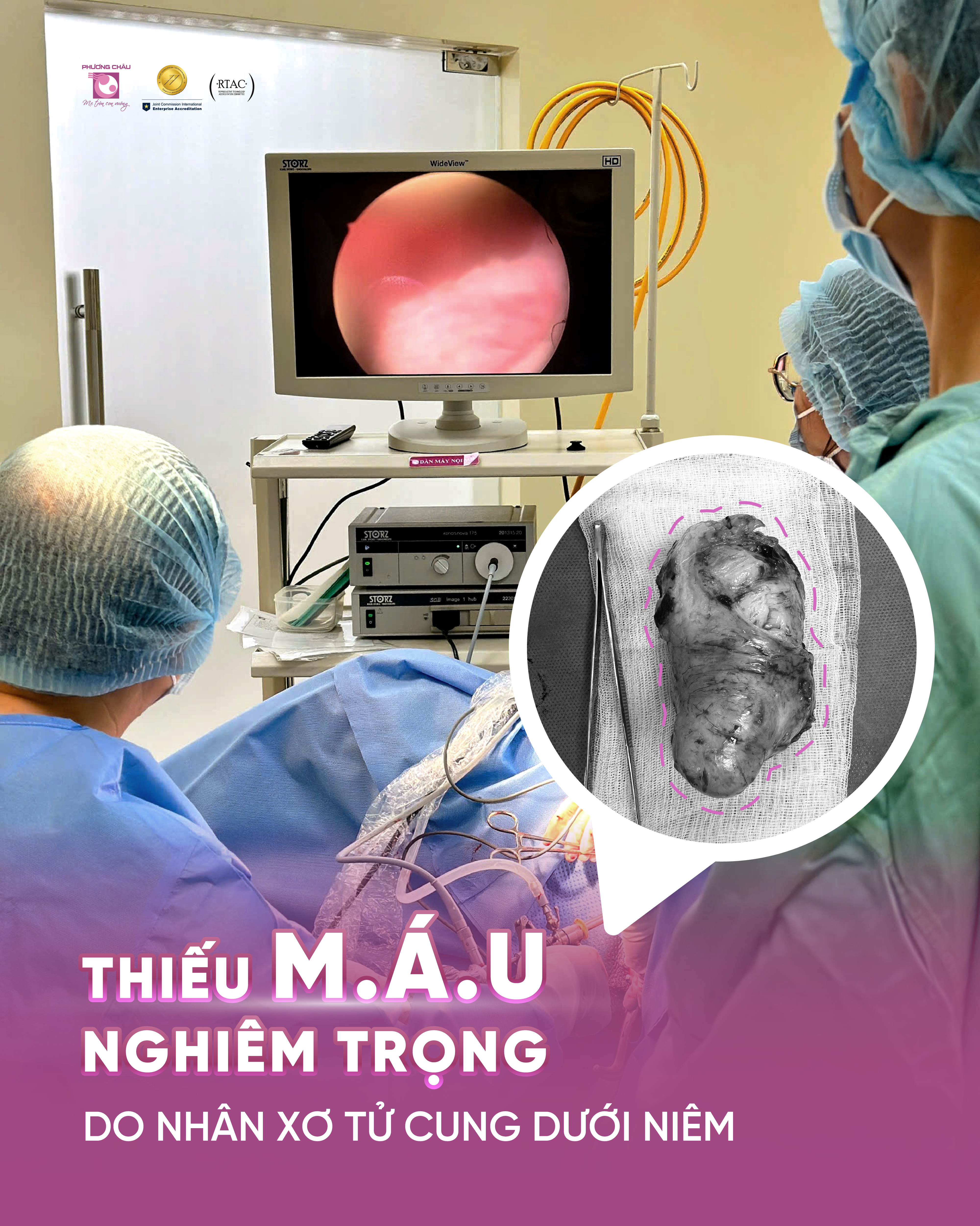 THIẾU M.Á.U NGHIÊM TRỌNG DO NHÂN XƠ TỬ CUNG DƯỚI NIÊM