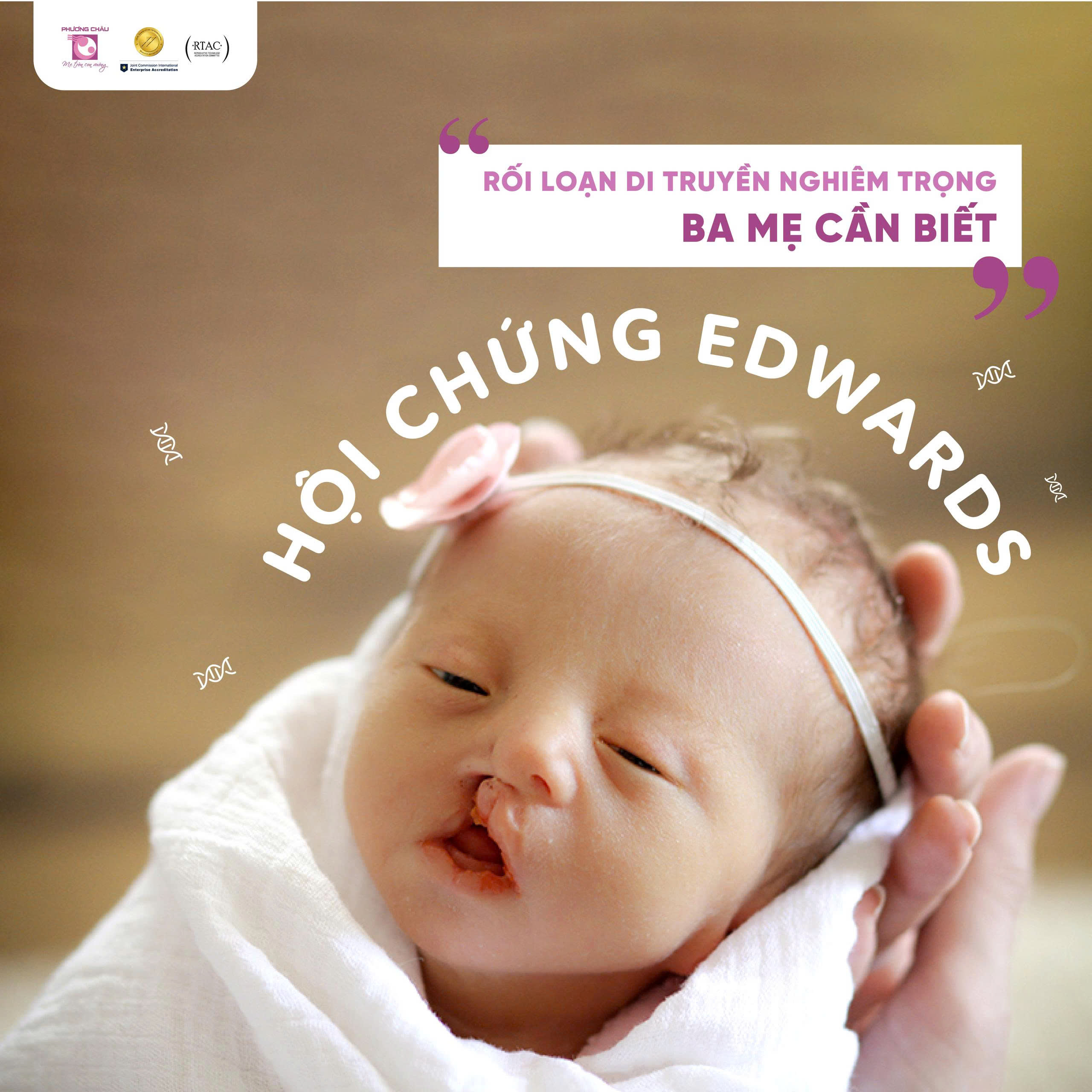 Hội chứng Edwards - Hội chứng nghiêm trọng ba mẹ cần biết