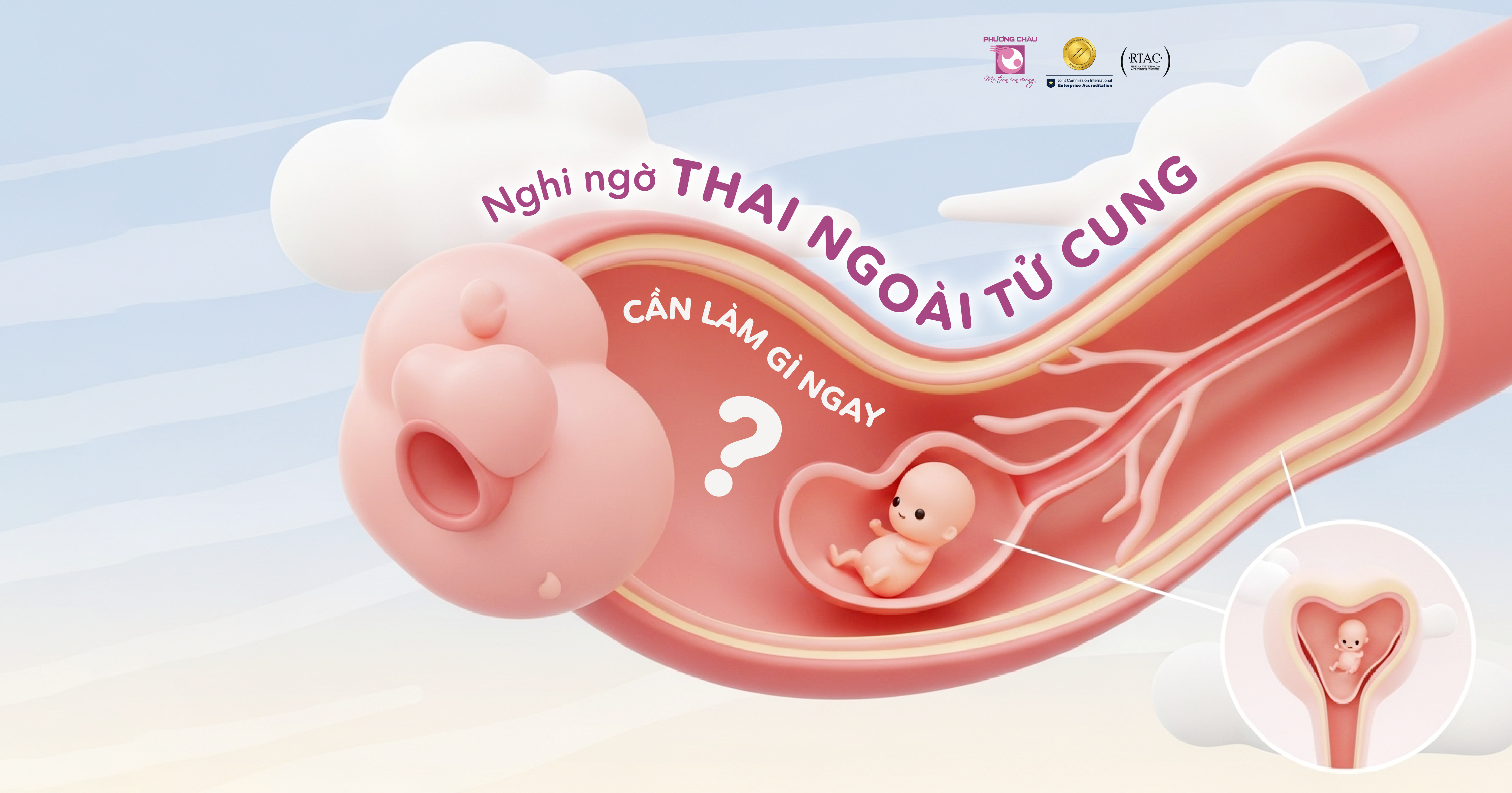 Cấp cứu thai ngoài tử cung vỡ choáng và lưu ý