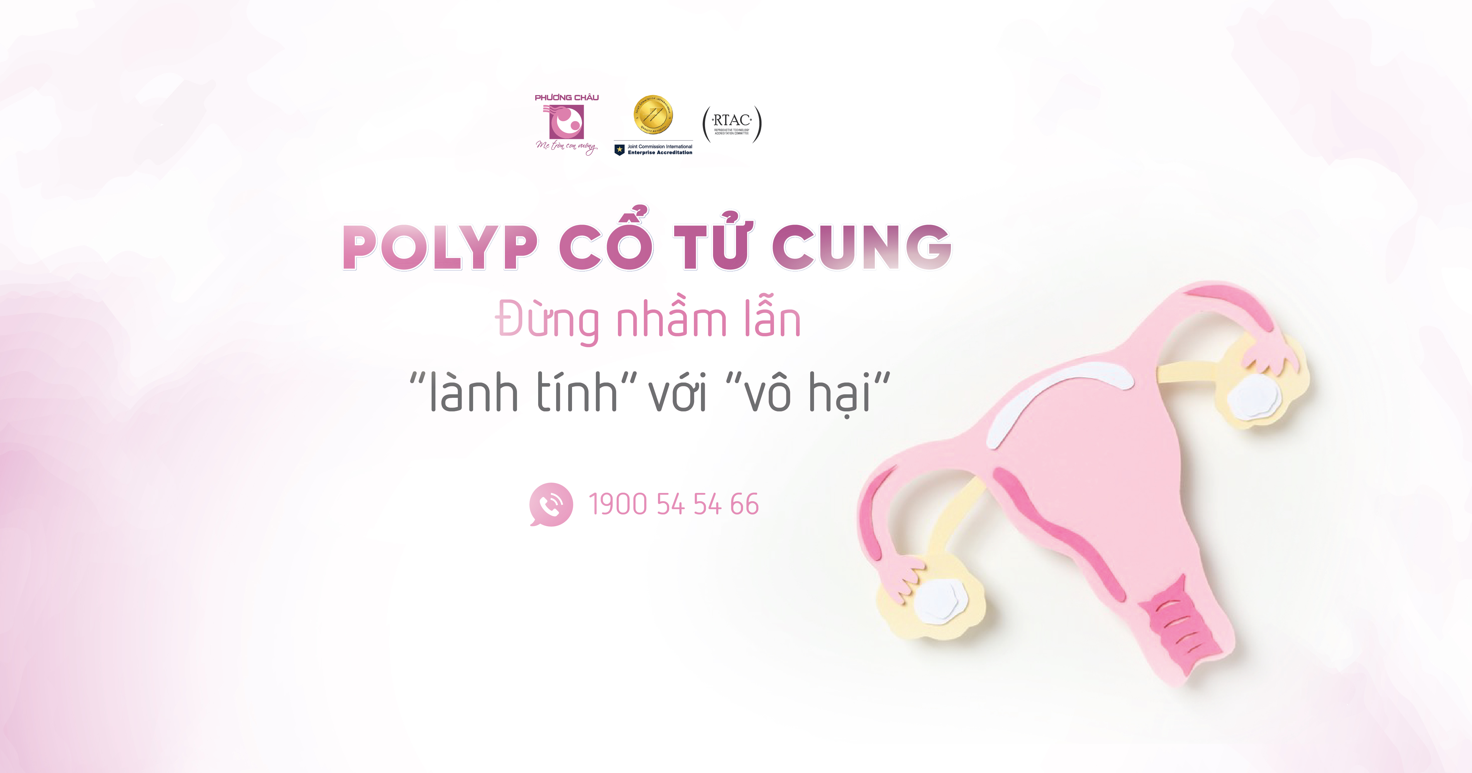 Polyp cổ tử cung – Đừng chủ quan với tổn thương tưởng chừng lành tính