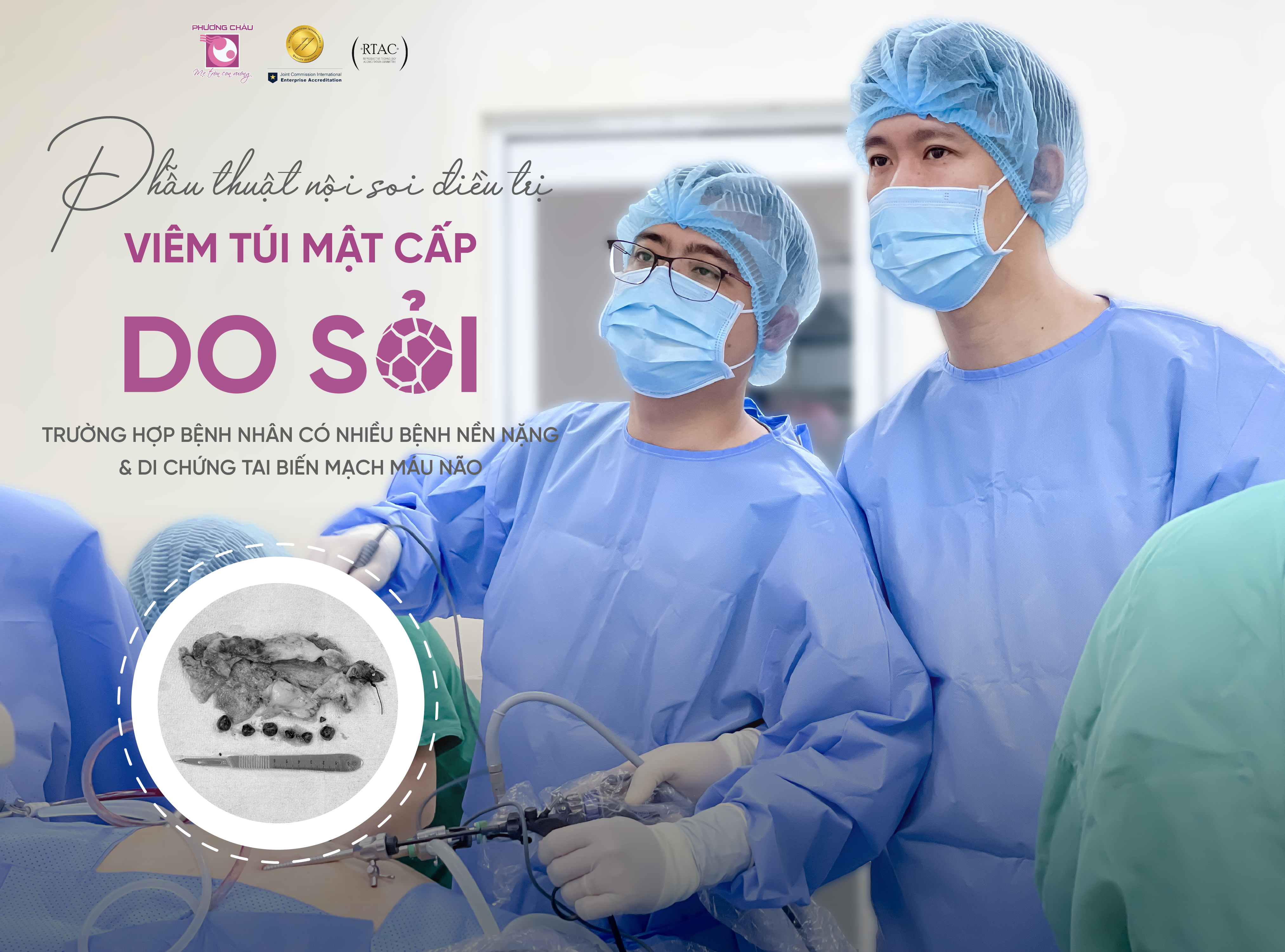 Phẫu thuật điều trị viêm túi mật cấp do sỏi cho bệnh nhân có nhiều bệnh nền, di chứng tai biến mạch máu não