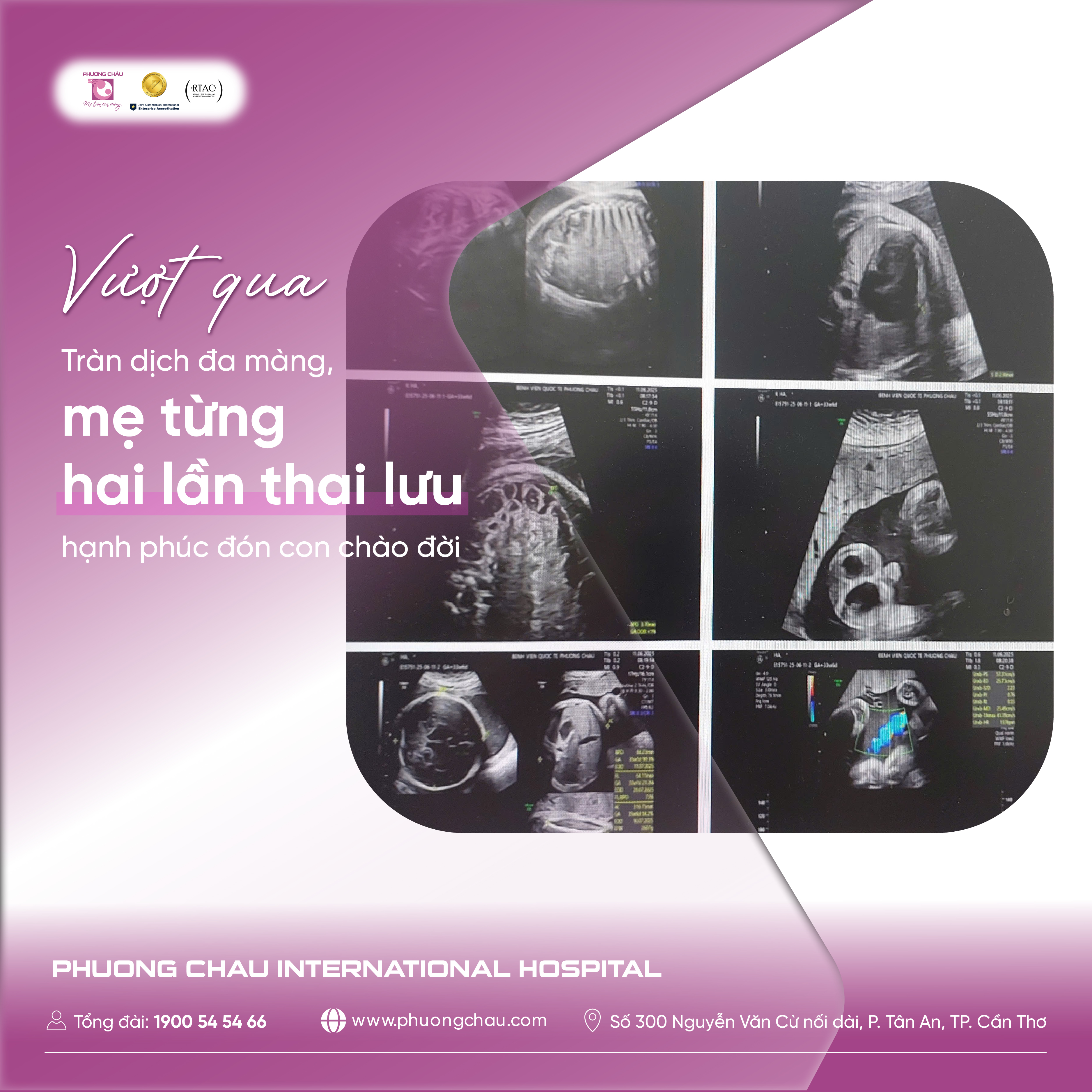 Vượt qua tràn dịch đa màng, mẹ từng hai lần thai lưu hạnh phúc đón con chào đời