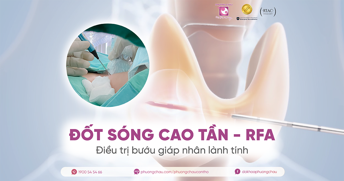 Điều trị bướu giáp nhân lành tính bằng đốt sóng cao tần (RFA)