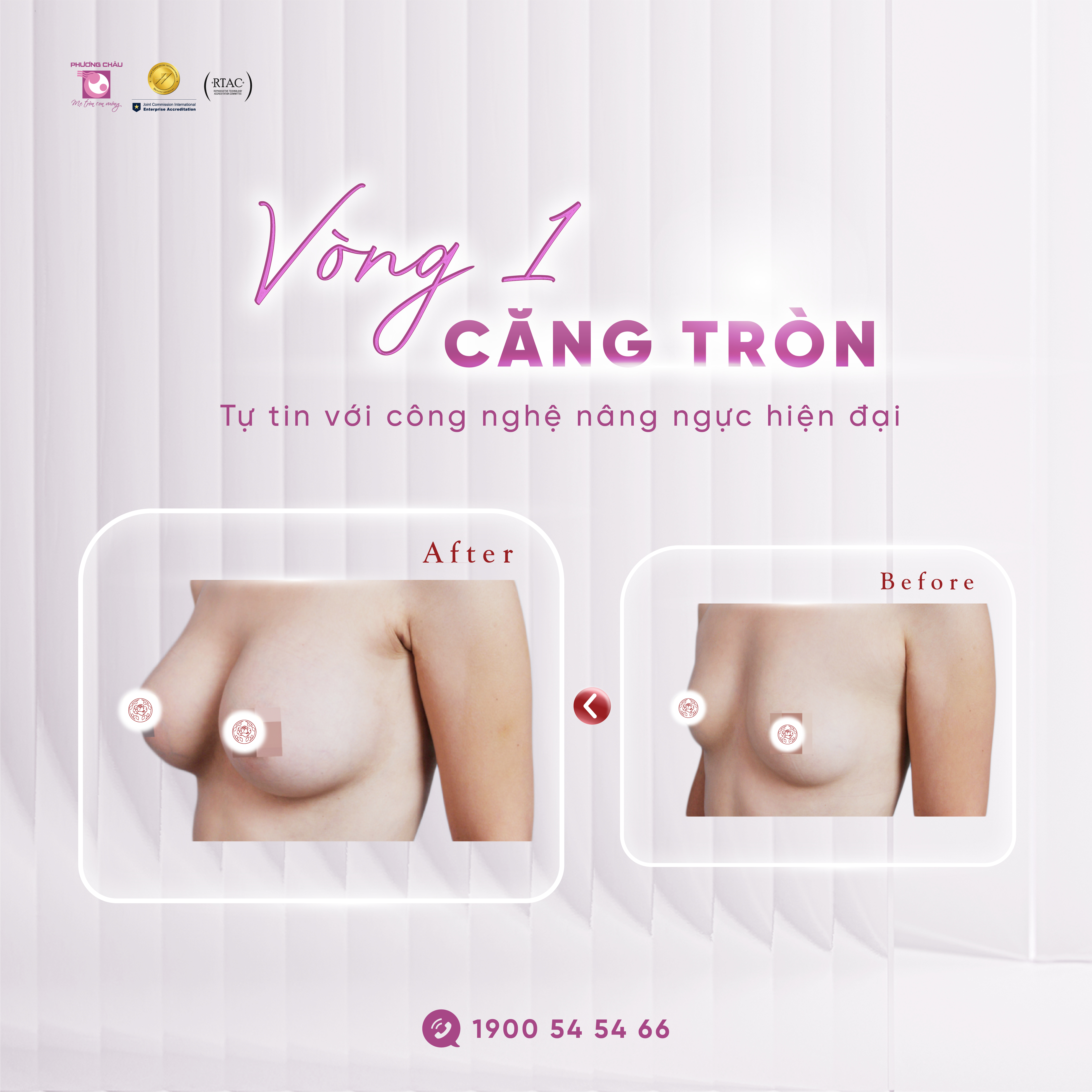 Vòng 1 căng tròn, tự tin với công nghệ nâng ngực hiện đại