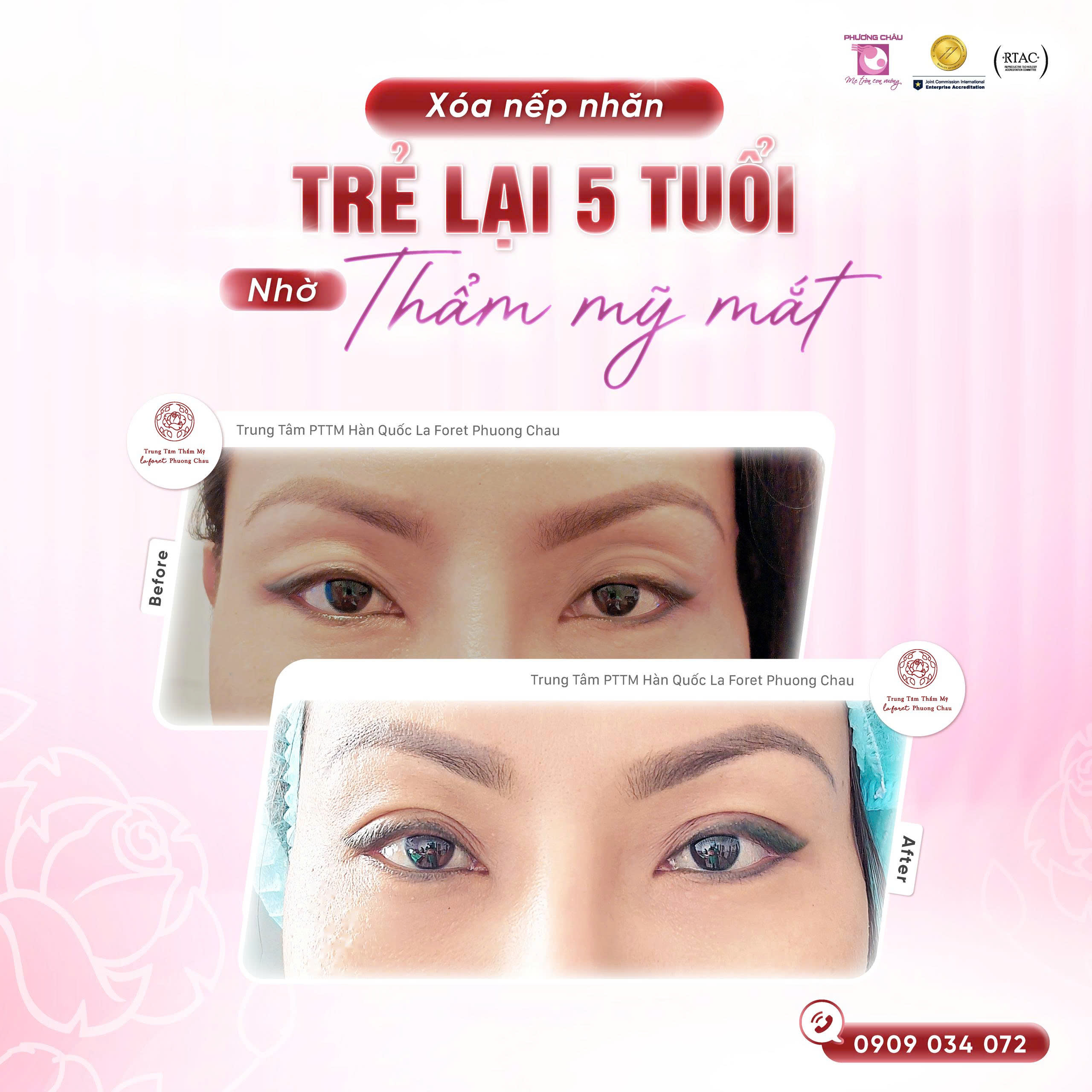 Xóa nếp nhăn – Trẻ lại 5 tuổi nhờ thẩm mỹ mắt