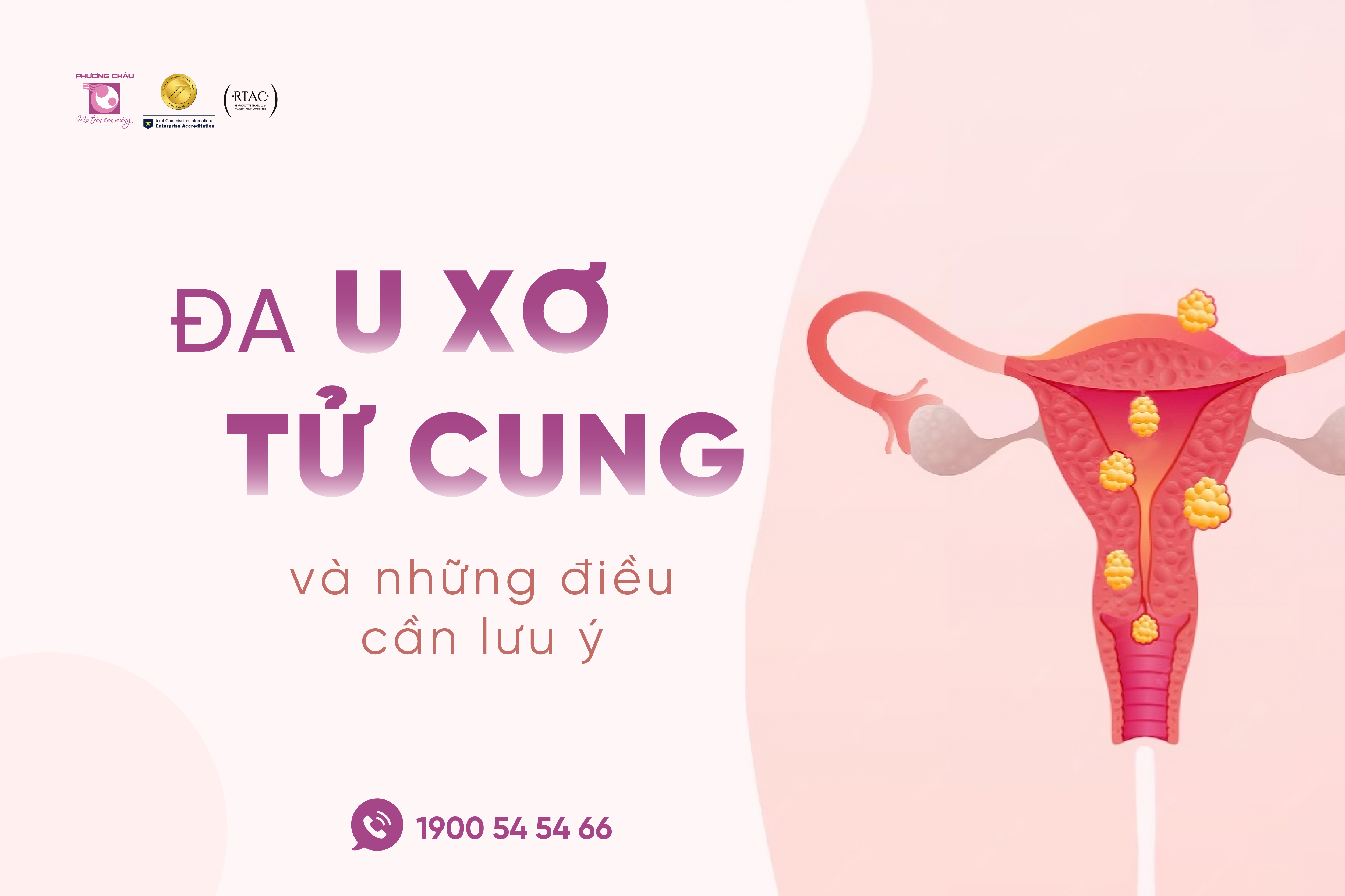 U xơ tử cung và những điều cần biết