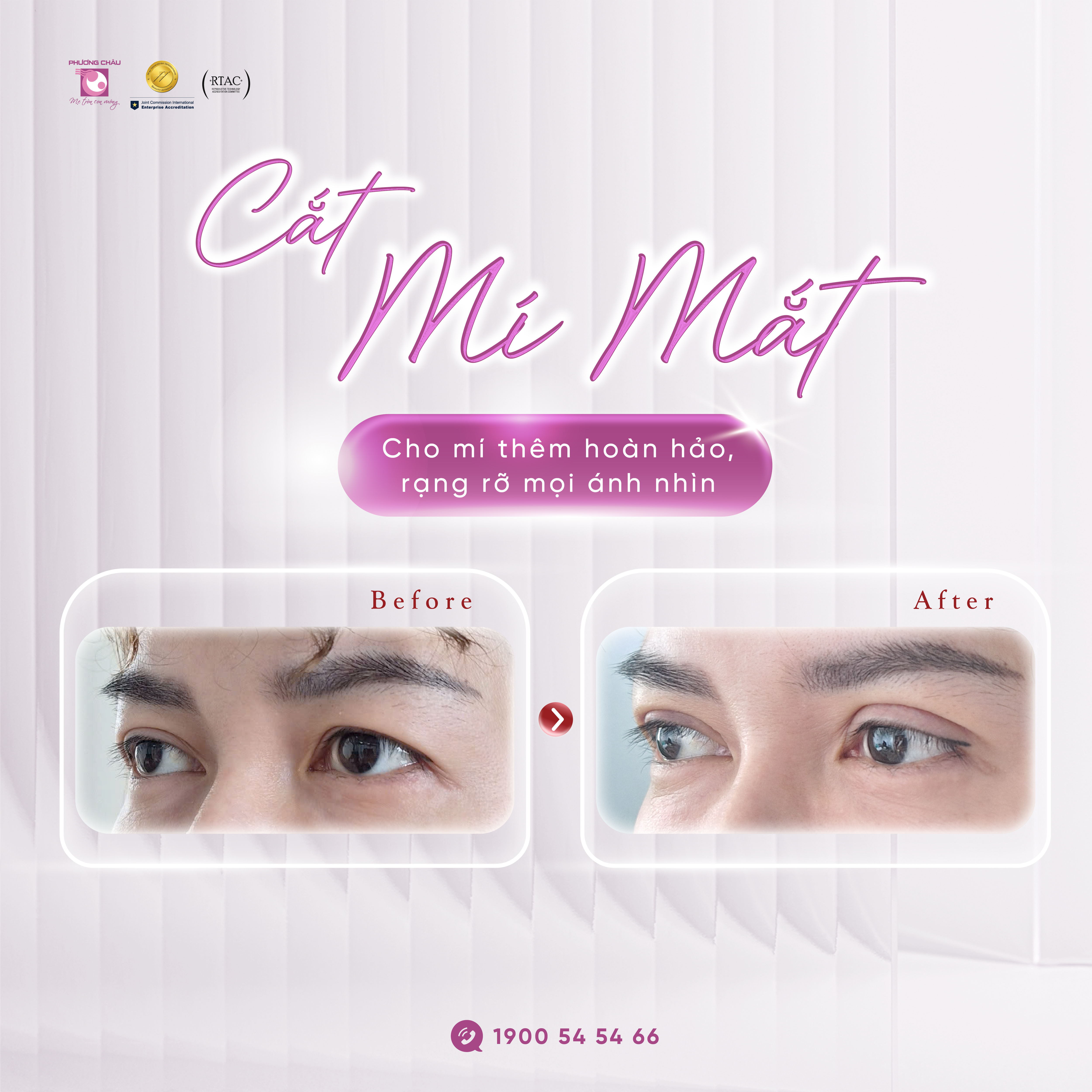 Giải pháp loại bỏ da chùng, mỡ thừa và tạo nếp mí hài hòa