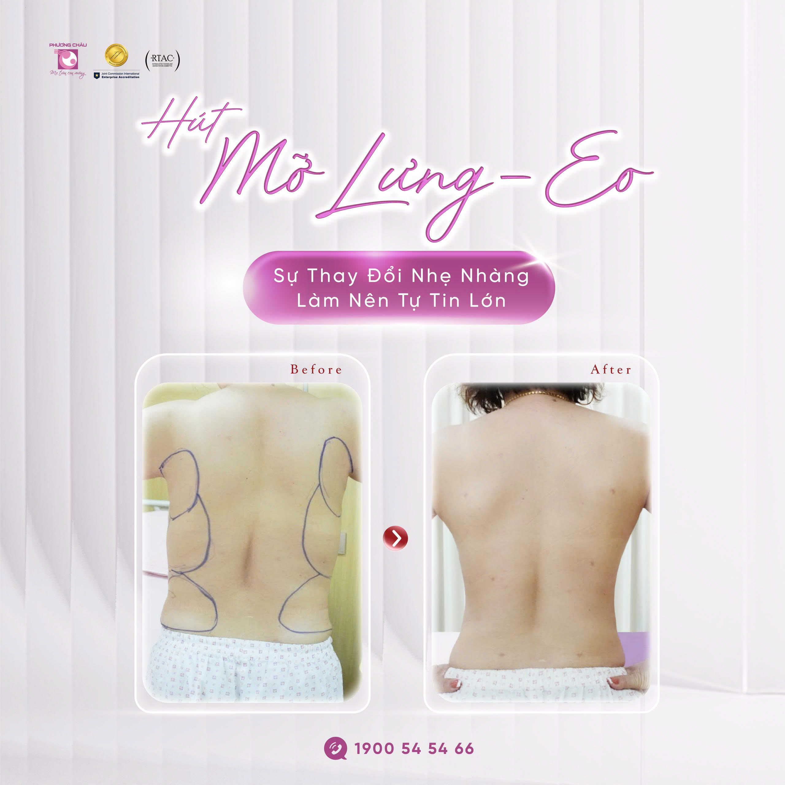 Hút Mỡ Lưng – Eo: Sự Thay Đổi Nhẹ Nhàng Làm Nên Tự Tin Lớn