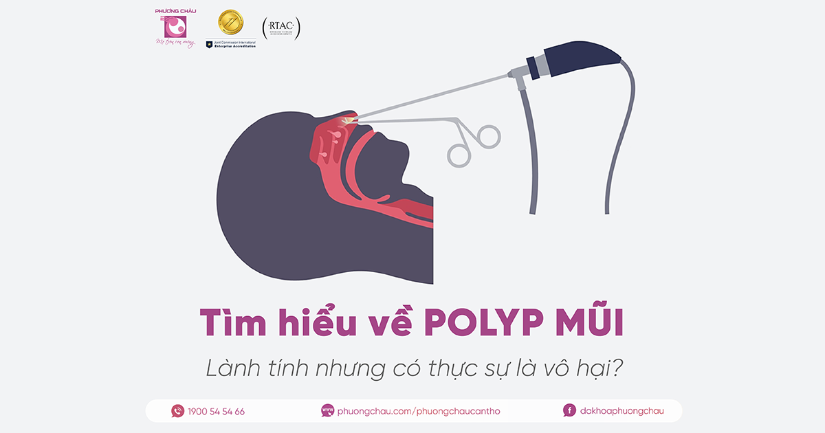 Polyp mũi: Lành tính nhưng có thực sự là vô hại?